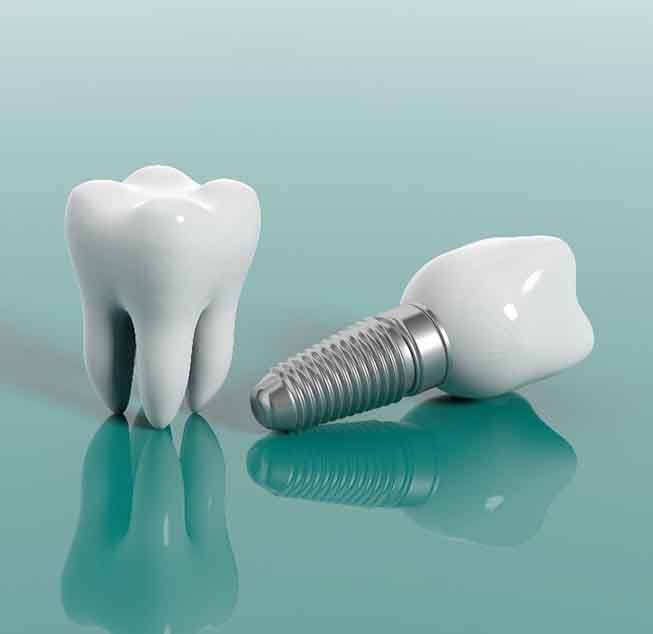 Dental implant and molar on green background