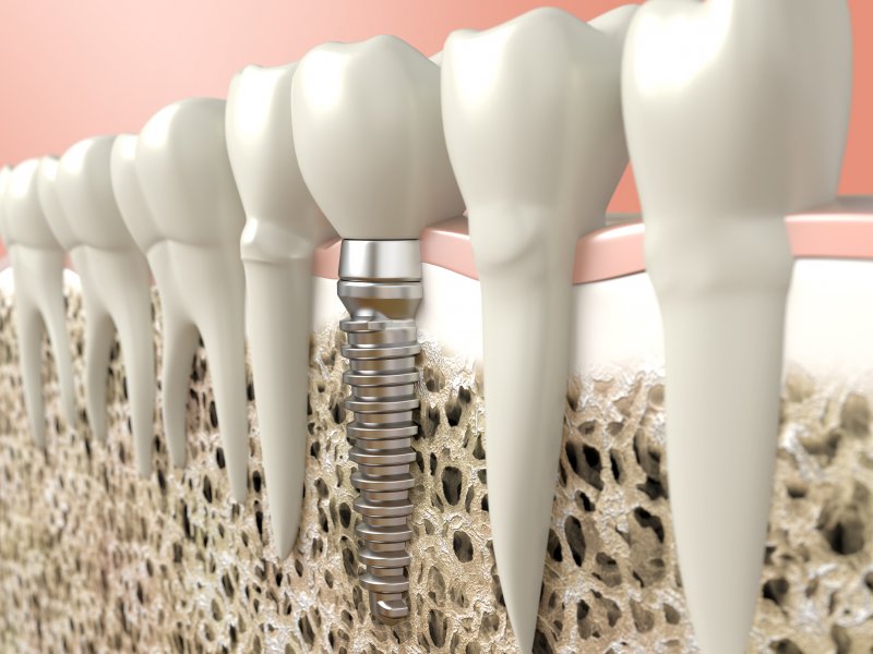 Digital illustration of dental implants